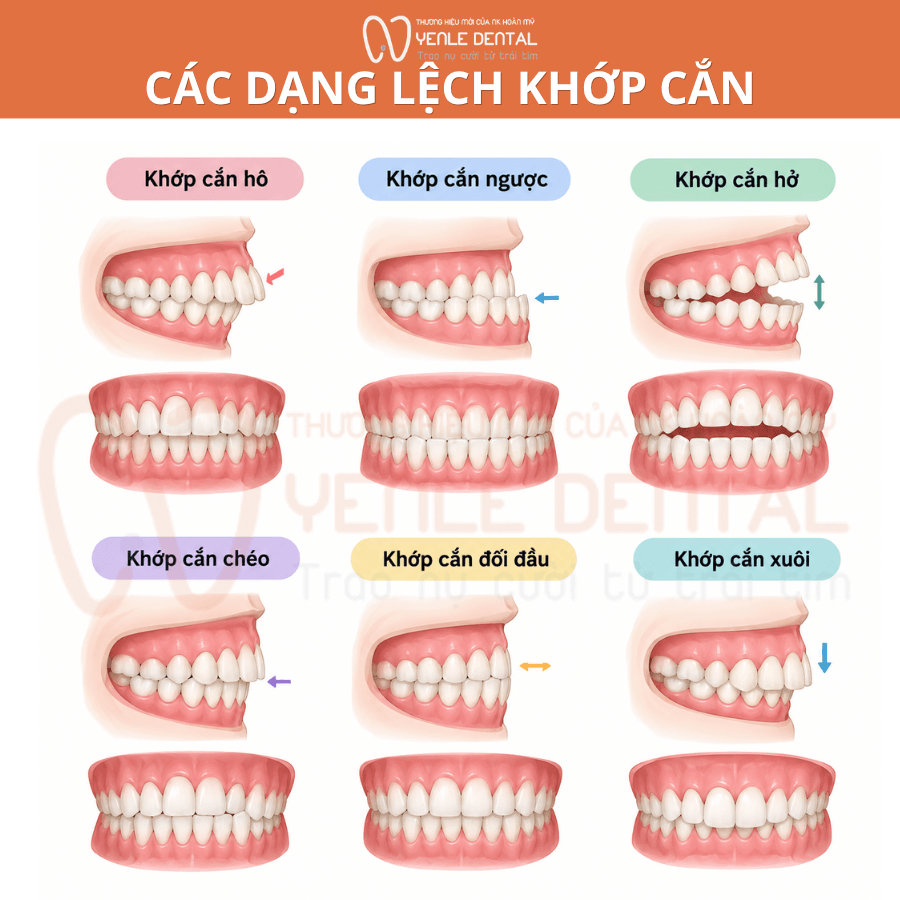 các dạng lệch khớp cắn phổ biến